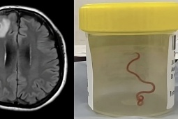 Thế giới - Bác sĩ sốc khi gắp ra sinh vật dài 8cm sống trong não người