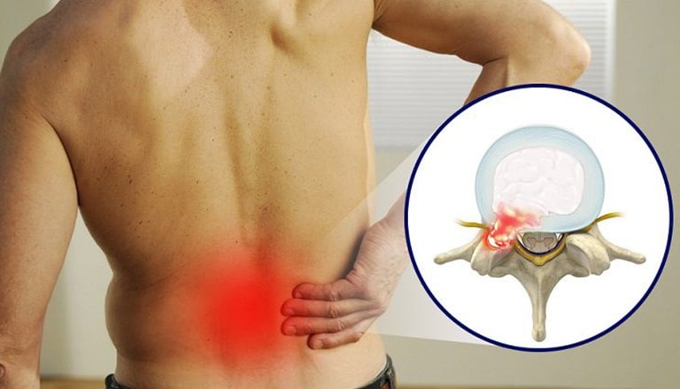 Thoát vị đĩa đệm thắt lưng gây đau vùng lưng dưới