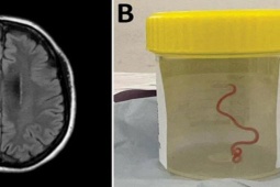Sức khỏe đời sống - Ca mổ lấy giun sống khỏi não người đầu tiên trên thế giới