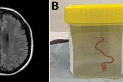 Ca mổ lấy giun sống khỏi não người đầu tiên trên thế giới
