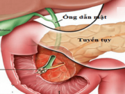 Sức khỏe đời sống - 5 loại thực phẩm &quot;giết chết&quot; tuyến tụy