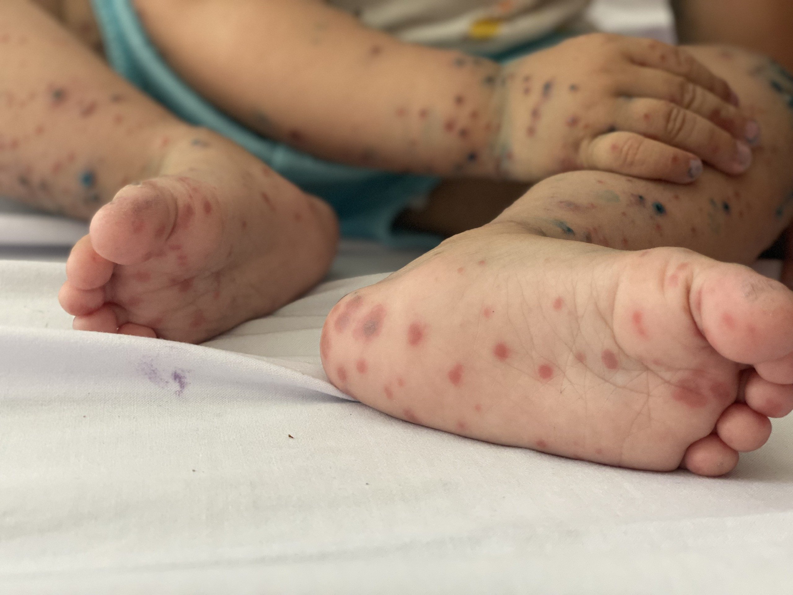 Tay chân miệng thường tăng mạnh vào khoảng tháng 9, tháng 10 hàng năm, trùng với mùa tựu trường