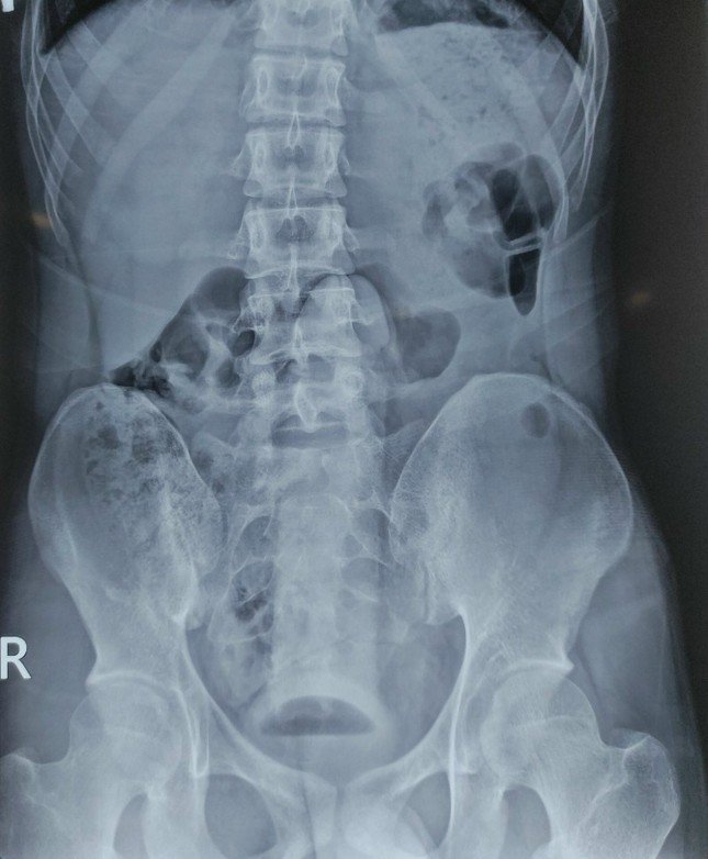 Hình ảnh X-quang cho thấy dương vật giả nằm trong đường tiêu hóa của người bệnh
