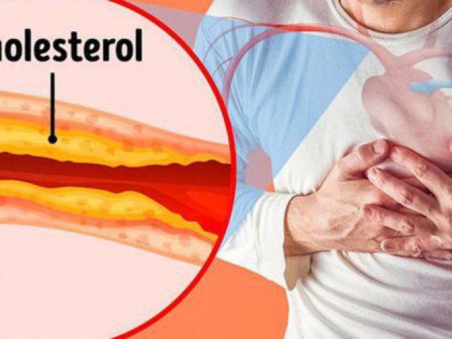 Sức khỏe đời sống - 3 nhóm thực phẩm làm tăng nguy cơ tắc nghẽn mạch máu, nếu xuất hiện 4 dấu hiệu này cần cảnh giác