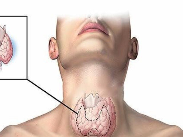 Dấu hiệu bất thường cảnh báo nguy cơ bị ung thư tuyến giáp, tuyệt đối không được bỏ qua