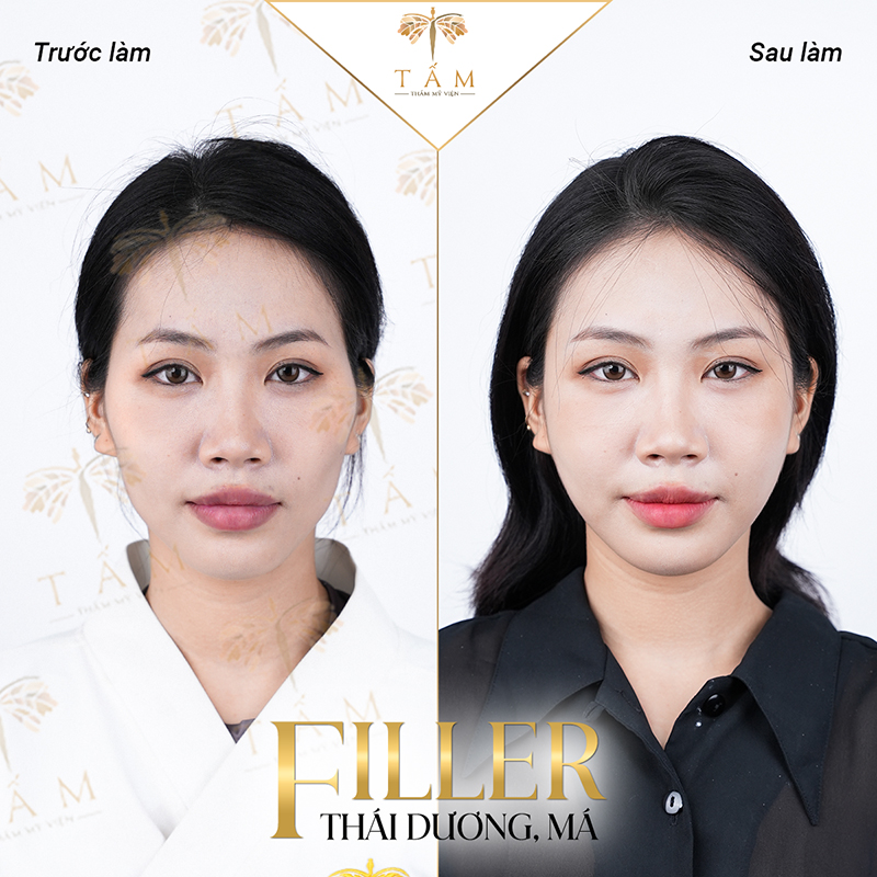 Lý do khiến các chị em lựa chọn tiêm filler tại Thẩm mỹ viện Tấm  - 1