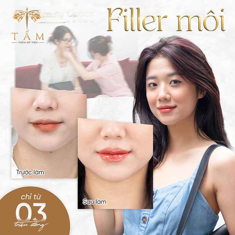 Lý do khiến các chị em lựa chọn tiêm filler tại Thẩm mỹ viện Tấm  - 6