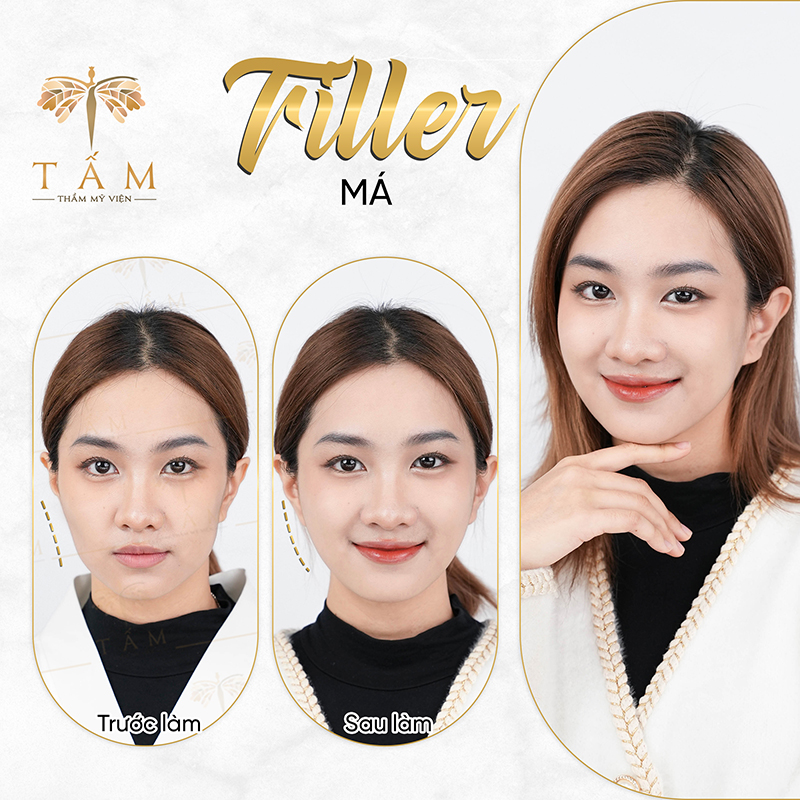 Lý do khiến các chị em lựa chọn tiêm filler tại Thẩm mỹ viện Tấm  - 4