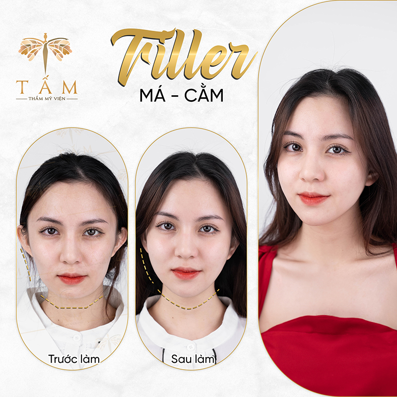 Lý do khiến các chị em lựa chọn tiêm filler tại Thẩm mỹ viện Tấm  - 3