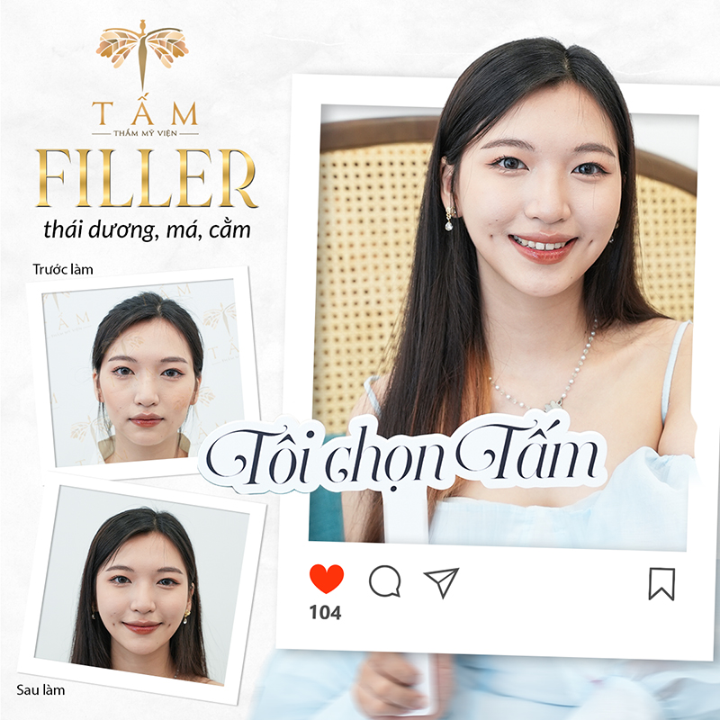 Lý do khiến các chị em lựa chọn tiêm filler tại Thẩm mỹ viện Tấm  - 5
