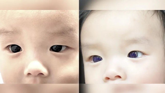 Đôi mắt nâu sẫm thường ngày của cậu bé (trái) chuyển sang màu xanh lam (phải) khi được điều trị bằng một loại thuốc kháng virus. (Ảnh: Jiravisitkul và cộng sự 2023, DOI)