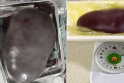 Sức khỏe đời sống - Lá lách người đàn ông to lên gấp 30 lần sau khi bụng căng cứng, vàng da