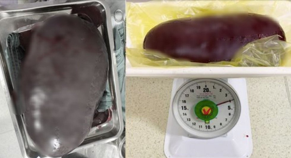 Lá lách khổng lồ, trọng lượng gấp gần 30 lần mức bình thường, được cắt khỏi cơ thể bệnh nhân. Ảnh: BVCC