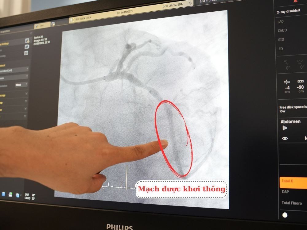 Động mạch mũ được khơi thông sau khi đặt stent