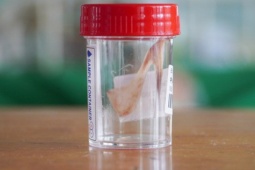 Nguy kịch vì tìm người "đẻ ngược" vuốt hóc xương