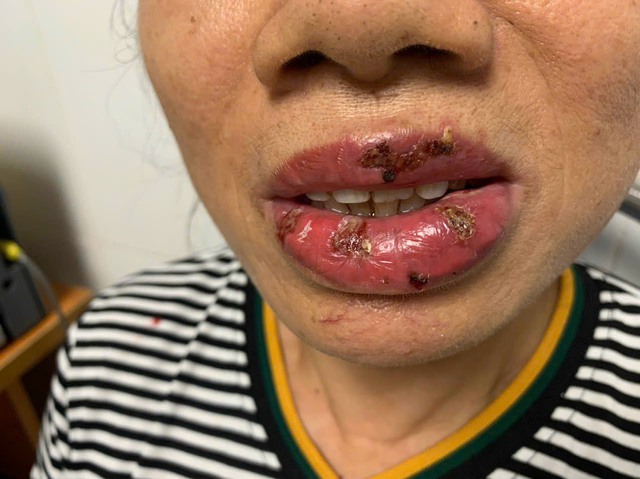 Người phụ nữ bị nhiễm trùng sau khi xăm môi.&nbsp;