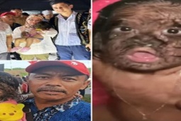 Phi thường - kỳ quặc - Bé gái 2 tuổi mắc "hội chứng người sói" bỗng trở nên nổi tiếng và được mệnh danh là “đứa trẻ đến từ thiên đường”