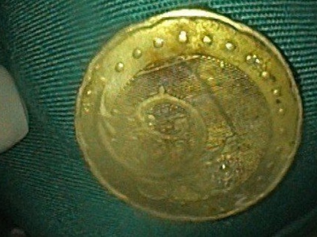 Sức khỏe đời sống - Ớn lạnh đồng xu mắc kẹt trong thực quản của bé gái 5 tuổi