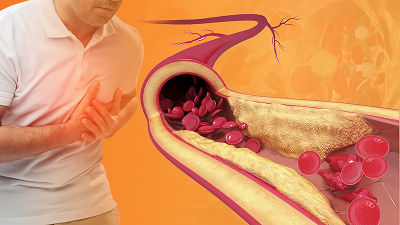 Các mảng bám nội mạc (mảng xơ vữa) xâm lấn vào lòng động mạch