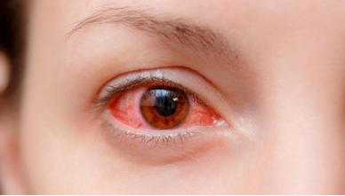 Dịch đau mắt đỏ năm nay phức tạp hơn hẳn mọi năm