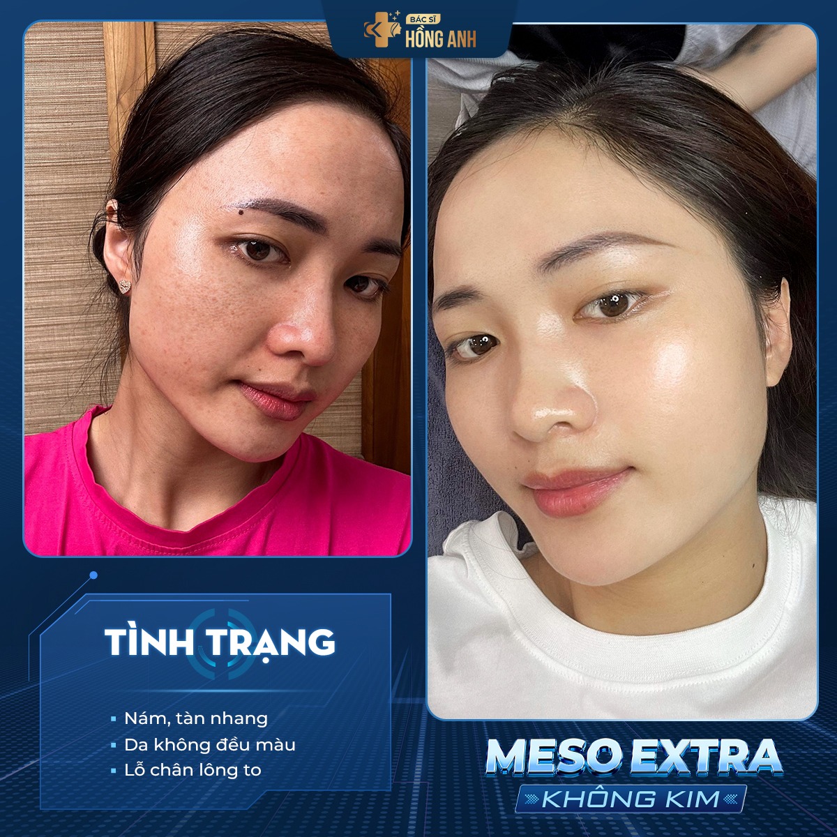 Thành quả sau quá trình điều trị Meso Extra không kim - Công nghệ tiên tiến bởi Bác sĩ Hồng Anh