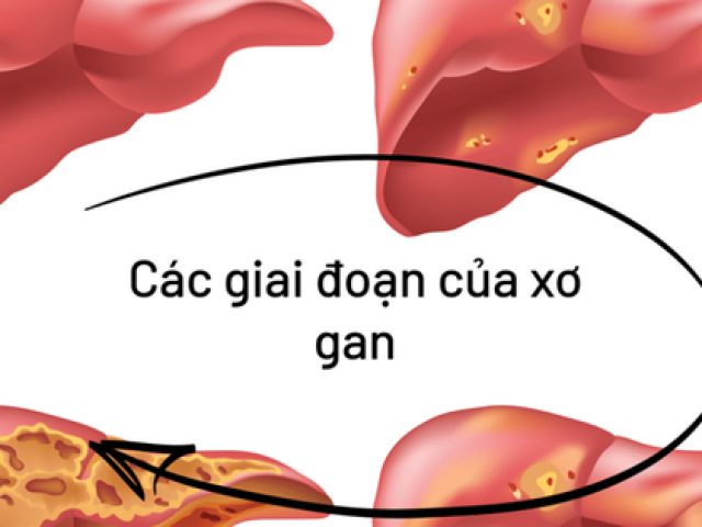 Sức khỏe đời sống - Cơ thể có 6 dấu hiệu này chứng tỏ gan của bạn đang nhiễm bệnh, cần khám gan càng sớm càng tốt!