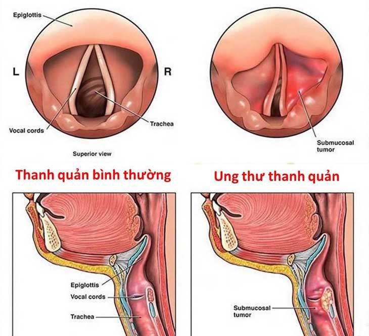 Bị khàn tiếng 2 tháng, đi khám phát hiện ung thư thanh quản, những dấu hiệu không thể coi thường - Ảnh 3.