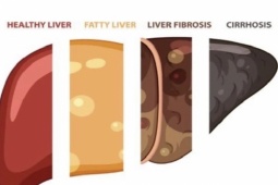 Sức khỏe đời sống - Không chỉ rượu, những thực phẩm này có thể dẫn đến bệnh gan nhiễm mỡ