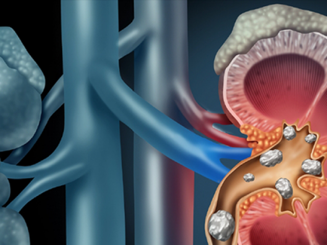 Sức khỏe đời sống - Thói quen tưởng vô hại nhưng lại là nguyên nhân khiến thận chứa cả ‘túi sỏi'