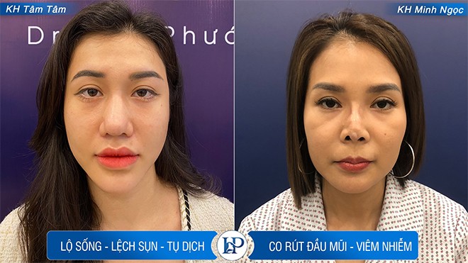 Thạc sĩ Bác sĩ Hữu Phước: Nâng sửa mũi hỏng và những rủi ro tiềm ẩn - Chia sẻ dưới góc nhìn chuyên gia - 2