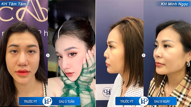 Thạc sĩ Bác sĩ Hữu Phước: Nâng sửa mũi hỏng và những rủi ro tiềm ẩn - Chia sẻ dưới góc nhìn chuyên gia - 4