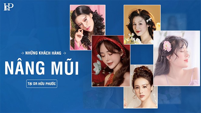 Thạc sĩ Bác sĩ Hữu Phước: Nâng sửa mũi hỏng và những rủi ro tiềm ẩn - Chia sẻ dưới góc nhìn chuyên gia - 5