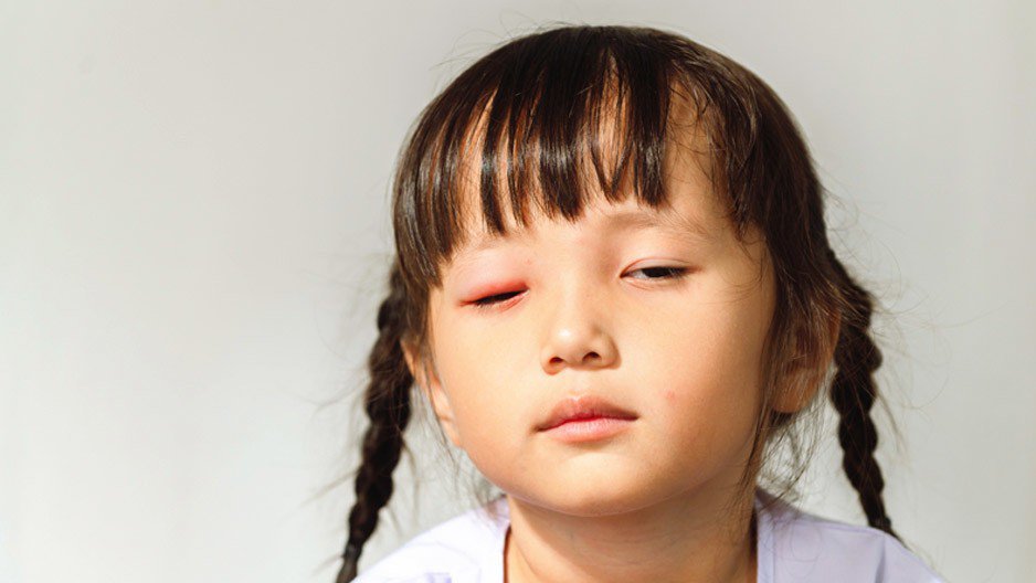 Số trẻ bị đau mắt đỏ có xu hướng tăng cao, nhiều ca chuyển nặng