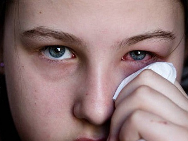 Sức khỏe đời sống - Đau mắt đỏ lây qua đâu, bao lâu thì khỏi?