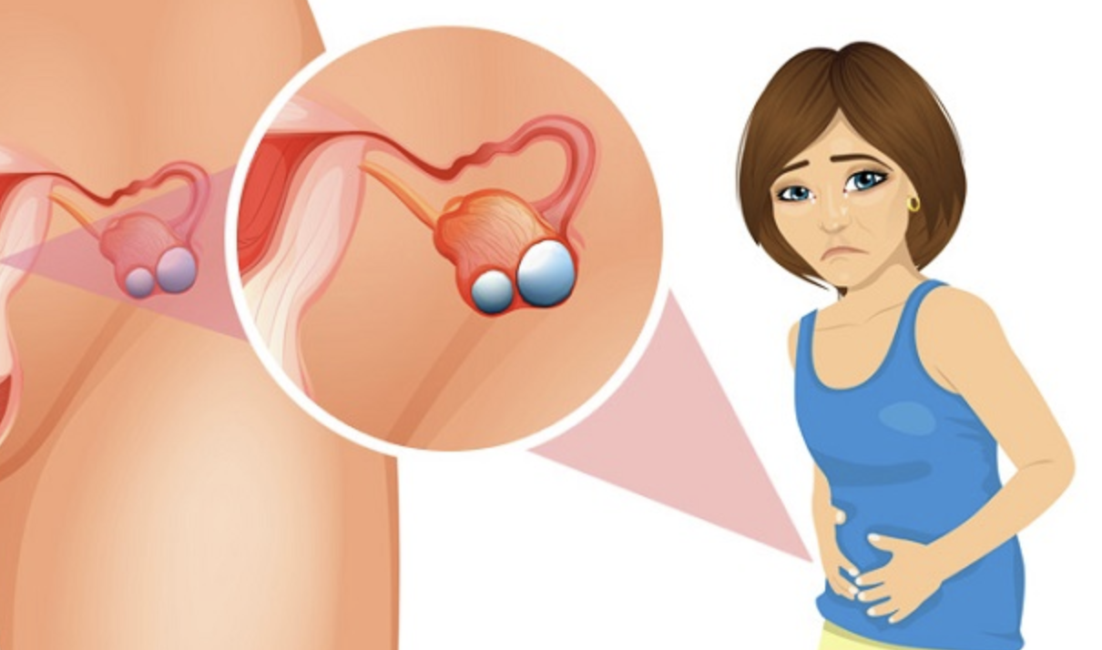 Vùng bụng dưới phình to do khối u nang tăng kích thước