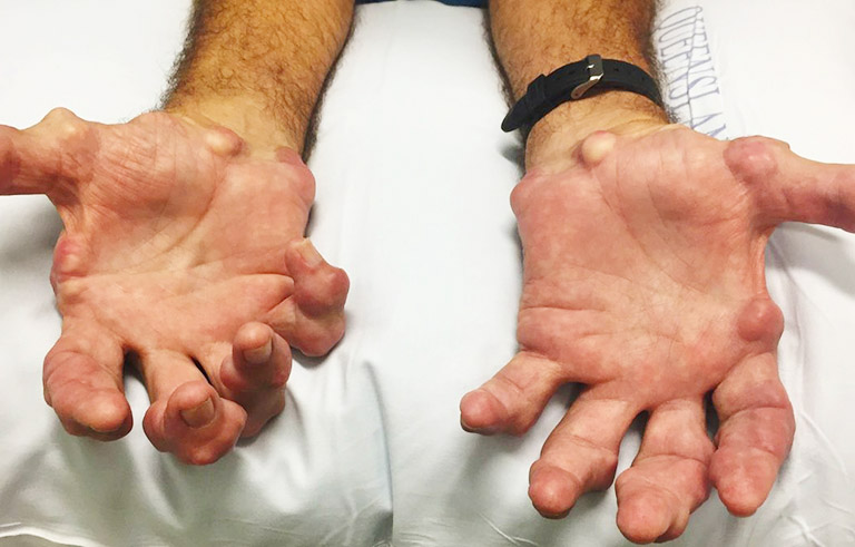 Viêm khớp dạng thấp đến giai đoạn nặng có thể xuất hiện hạt thấp dưới da