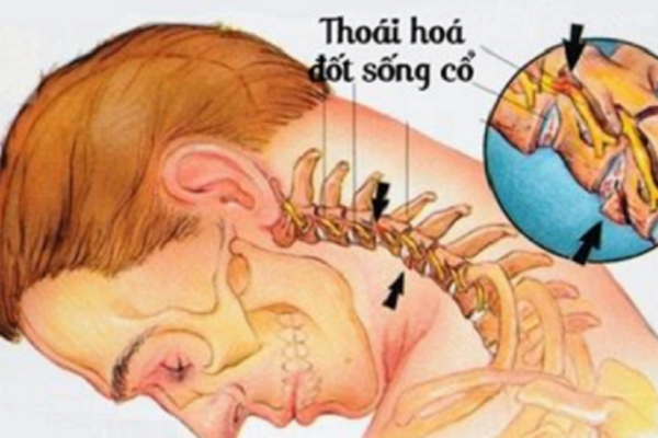 Thoái hóa đốt sống cổ gây đau mỏi cổ vai gáy, tê bì tay chân