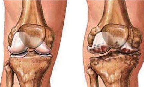 Khớp bị nhiễm khuẩn là một trong những nguyên nhân dẫn đến viêm khớp dạng thấp