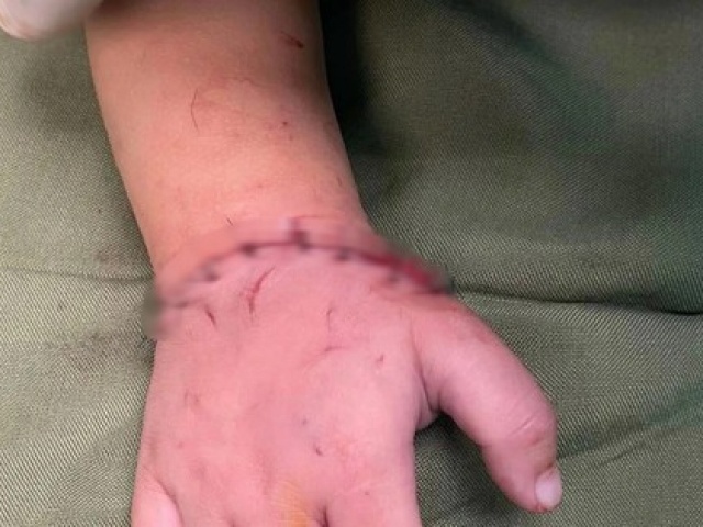 Tin tức trong ngày - Bé gần 18 tháng tuổi bị máy cắt đá của gia đình cắt đứt lìa bàn tay