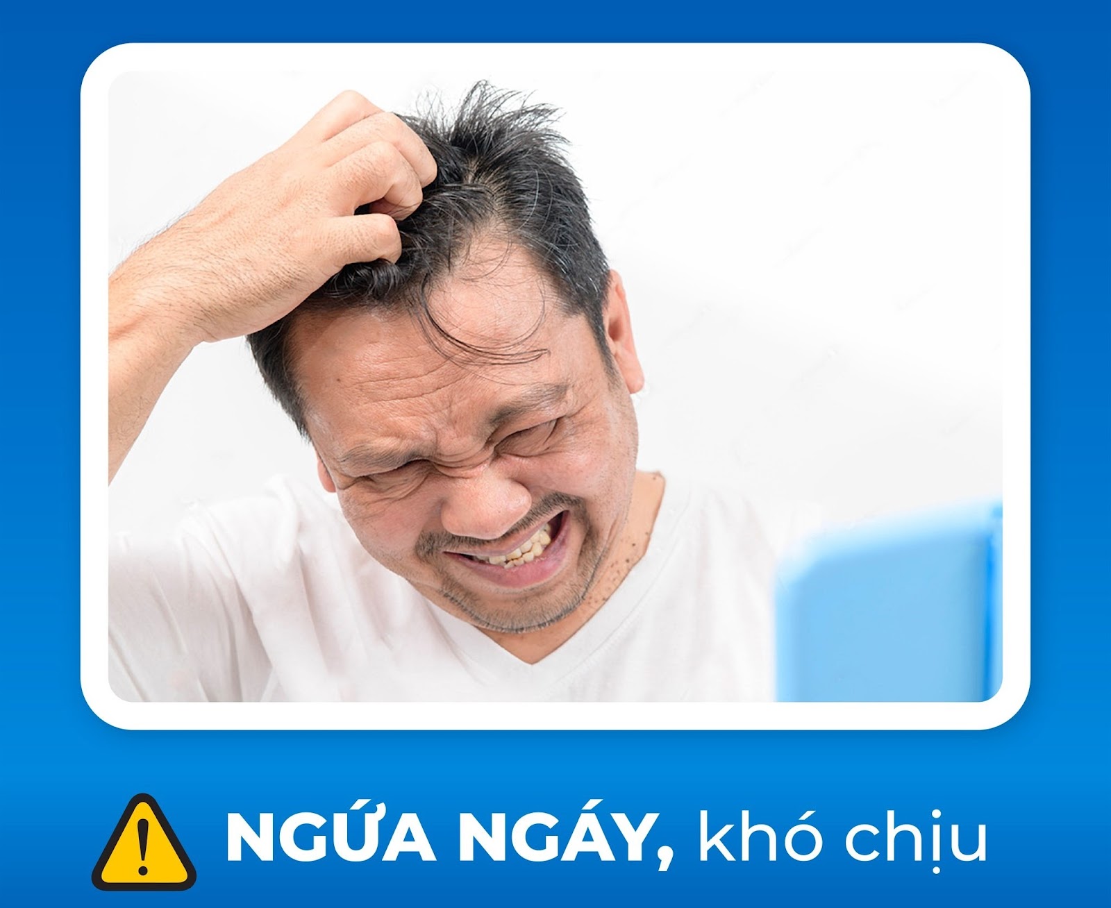 Gàu ngứa khiến nam giới ngứa ngáy, khó chịu, thậm chí hói đầu
