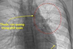 Đau ngực kèm khó thở, thanh niên 17 tuổi phát hiện bệnh hiếm gặp