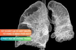 Tin tức sức khỏe - Căn bệnh phổi “quái ác” mà nhiều người có thể mắc phải - Xem ngay để phòng tránh