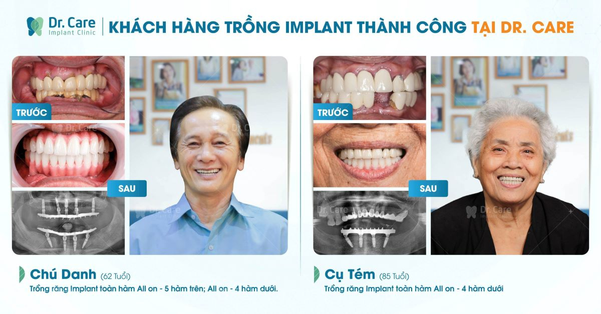 Dr. Care nha khoa chuyên sâu đáp ứng&nbsp; yếu tố thực hiện phục hình tức thì sau cùng trên Implant.&nbsp;