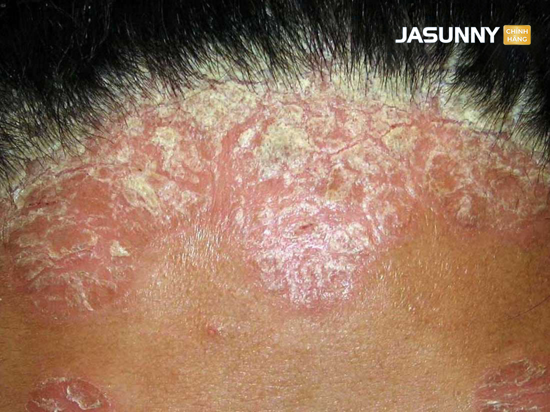 Gàu, nấm, ngứa da đầu dai dẳng thường gặp ở nam giới&nbsp;