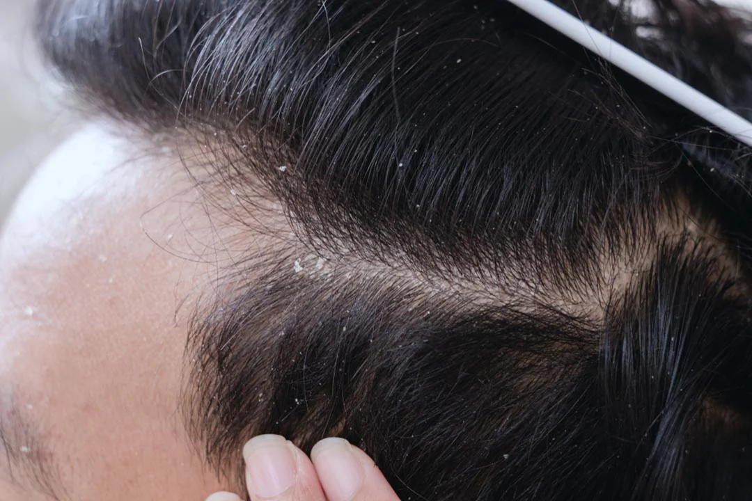 Gàu có thể là triệu chứng dị ứng dầu gội