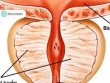 Có thể dự đoán tái phát ung thư tuyến tiền liệt sớm hơn 10 năm
