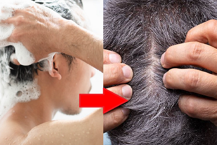 Không dùng đúng loại dầu gội trị ngứa phù hợp là lý do đầu càng gội càng ngứa