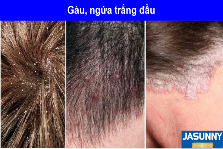 Rất nhiều&nbsp;nam giới bị gàu, nấm, ngứa dai dẳng do nấm Pityrosporum.