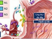Sức khỏe đời sống - Ung thư dạ dày: Nguyên nhân, biểu hiện, cách điều trị và phòng bệnh