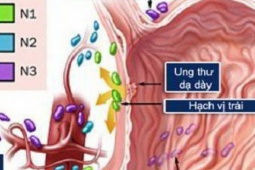 Ung thư dạ dày: Nguyên nhân, biểu hiện, cách điều trị và phòng bệnh